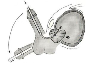 Endoscopic penis enlargement surgery scheme