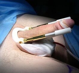 How an operation is performed to increase the penis