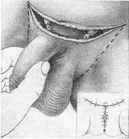 Surgical enlargement of the penis by extracting its hidden part